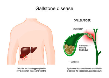 Gallbladder anatomy diagram showing gallstones, bile duct, and liver